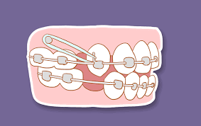 Dental Braces Box Hill 