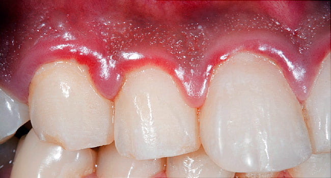 Gum Disease Symptoms and Treatment Box Hill