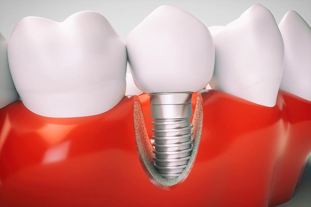 Dental Implants Mount Waverley Middleborough Dental Care